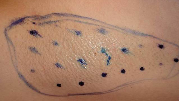 Cura dell'iperidrosi con il botox